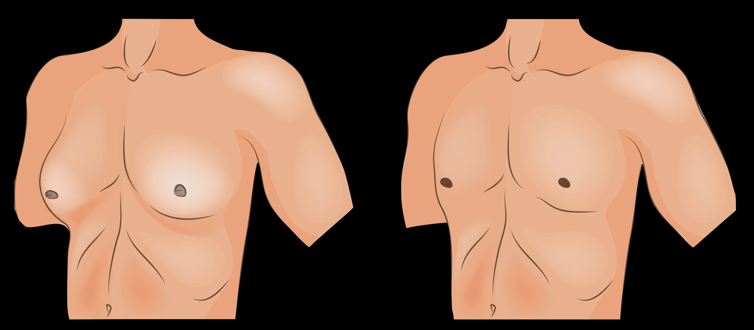 Door liposuctie met hoge definitie te combineren met radiofrequentie wordt de mannelijke borstcontour hersteld en wordt mannelijke gynaecomastie behandeld. Als er klierweefsel achterblijft, is een kleine incisie rond het tepelhof nodig voor klierexcisie.