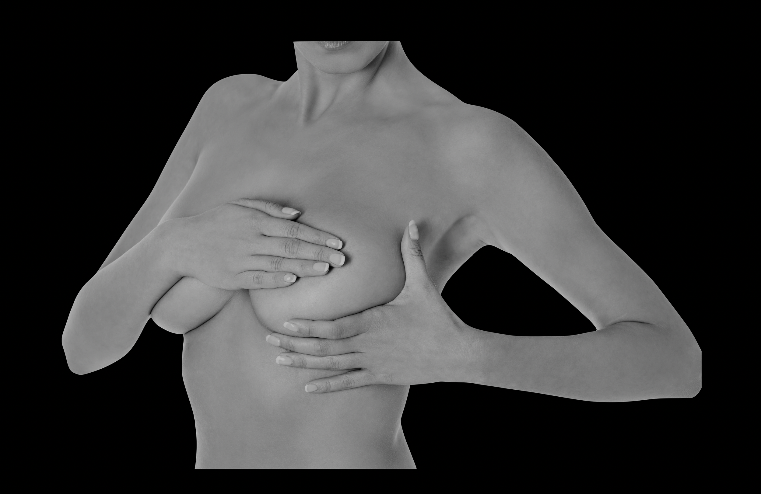 Borstlift of mastopexie door Dr Karl Waked ter verbetering van ptotische, verslapte of uitgezakte borsten en ter verbetering van de esthetiek en verjonging van de borst.