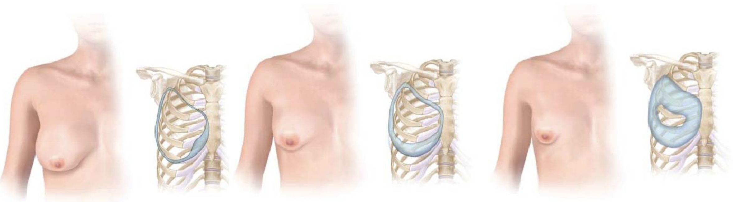Bij een tubureuze borst belemmert een vernauwende ring de normale borstontwikkeling, waardoor een vernauwde borst ontstaat. Er zijn verschillende graden van tubureuze borsten, afhankelijk van de anatomie van de vernauwende ring.