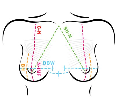Tissue based planning en borstmetingen voor borstvergroting of boobjob door Dr. Karl Waked