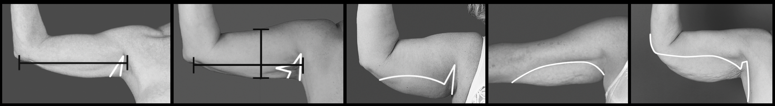 Litteken van een armlift of brachioplastiek door combinatie van liposuctie en huidexcisie