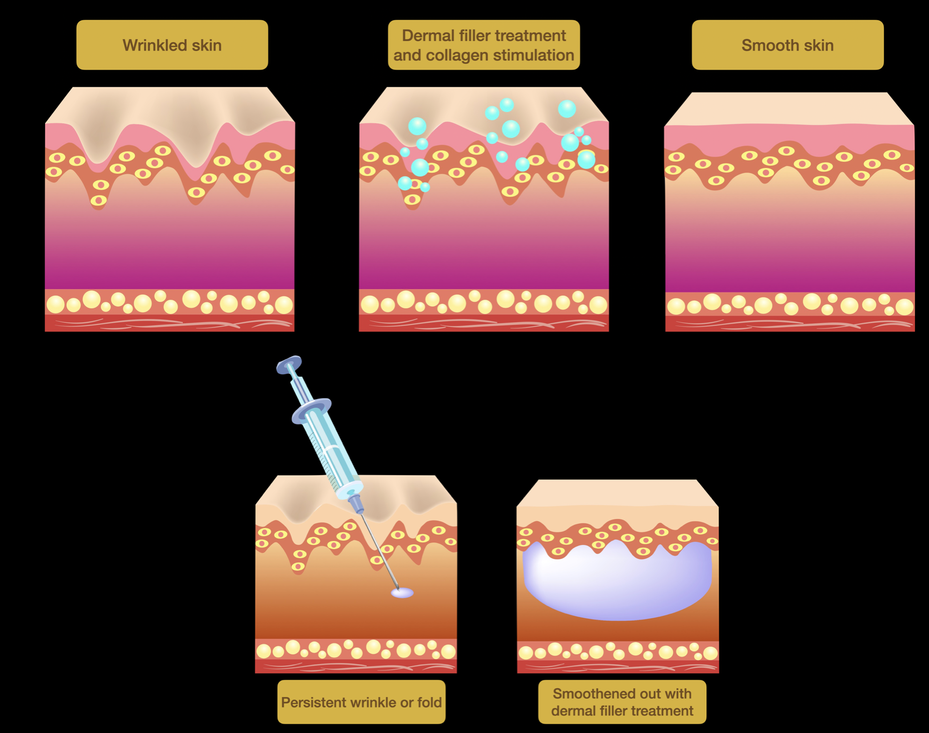 Een behandeling met dermale fillers kan resulteren in een volumineus en huidverjongend effect, door stimulering van de collageen- en elastineproductie.