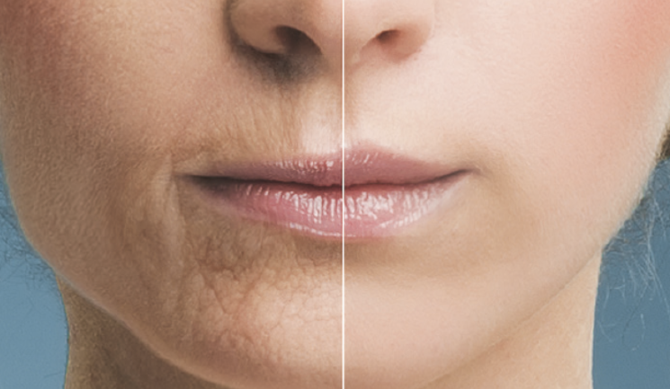Een ouder wordende lip wordt langer en dunner met minder vermillion en meer rimpels