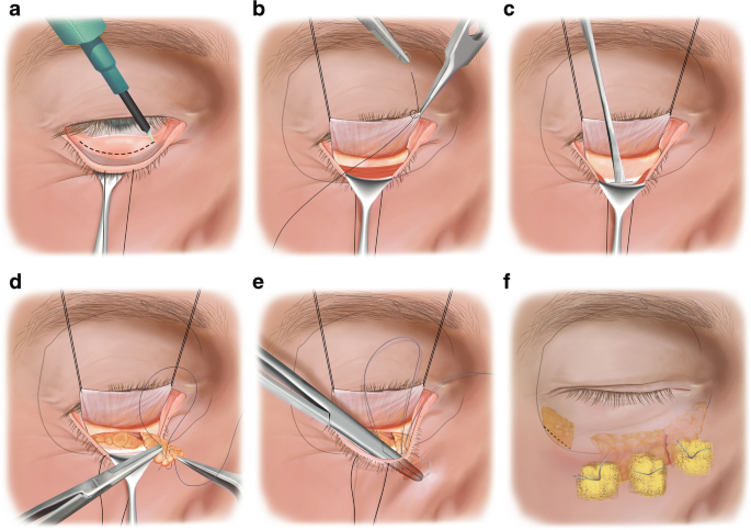 Onderste ooglid correctie of blepharoplastie via transconjunctivale benadering door dr. Karl Waked voor esthetiek en verjonging van het gezicht