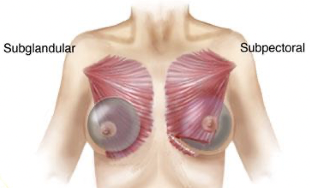 Afhankelijk van de kwaliteit en dikte van de borsthuid kan het implantaat achter (sub musculair of sub pectoraal) of voor de spier worden geplaatst.