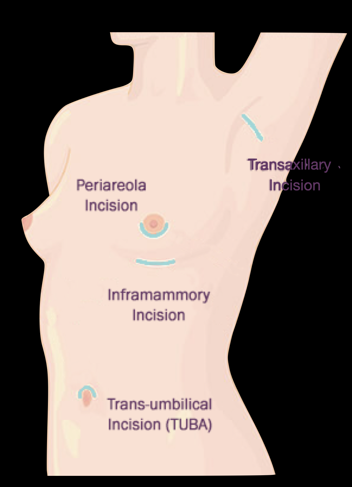 Incisie voor borstvergroting: inframammaire plooi, peri-areolair, axillair, via de navel.