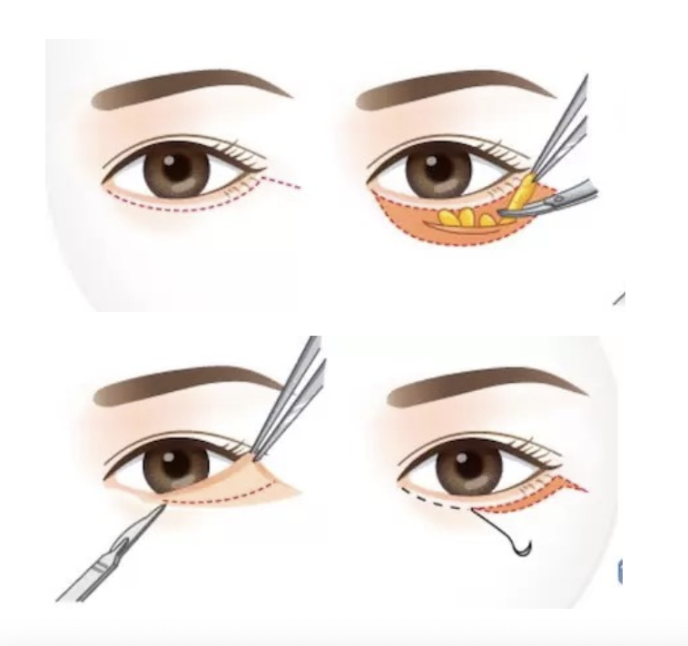 Onderste ooglid correctie of blepharoplastie via open benadering door dr. Karl Waked voor esthetiek en verjonging van het gezicht