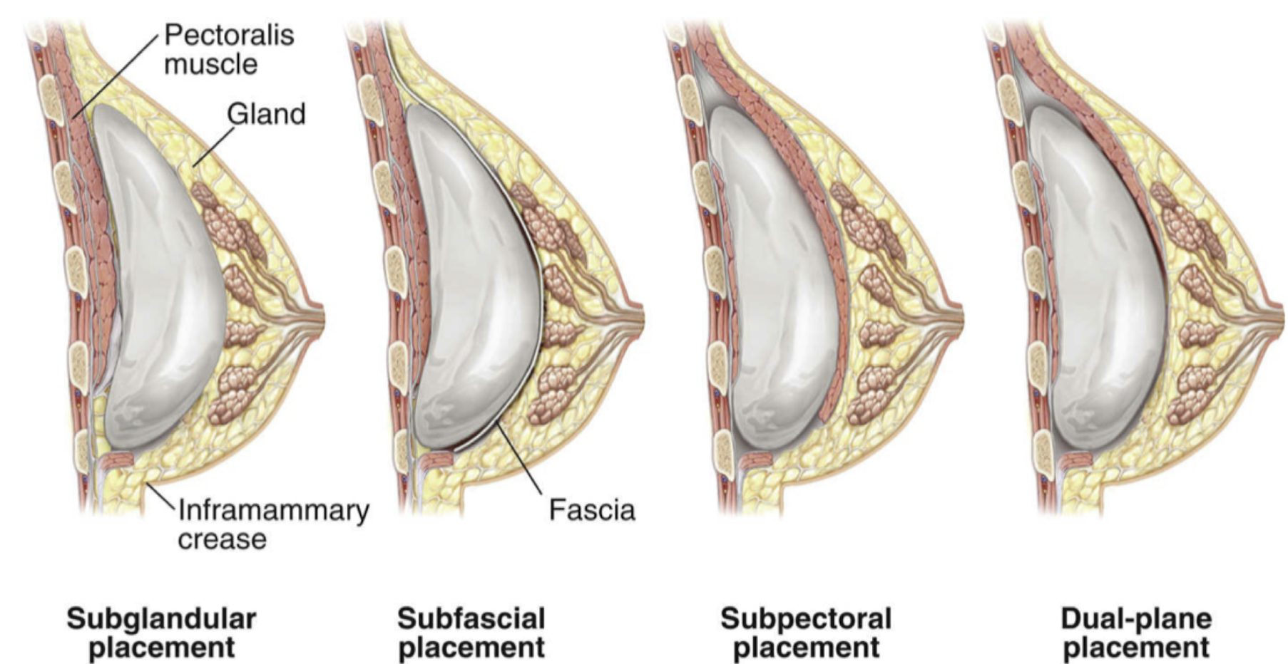 Borstimplantaten kunnen in 4 verschillende vlakken worden geplaatst, afhankelijk van verschillende factoren: achter de spier, voor de spier, onder de spierfascia, dual plane