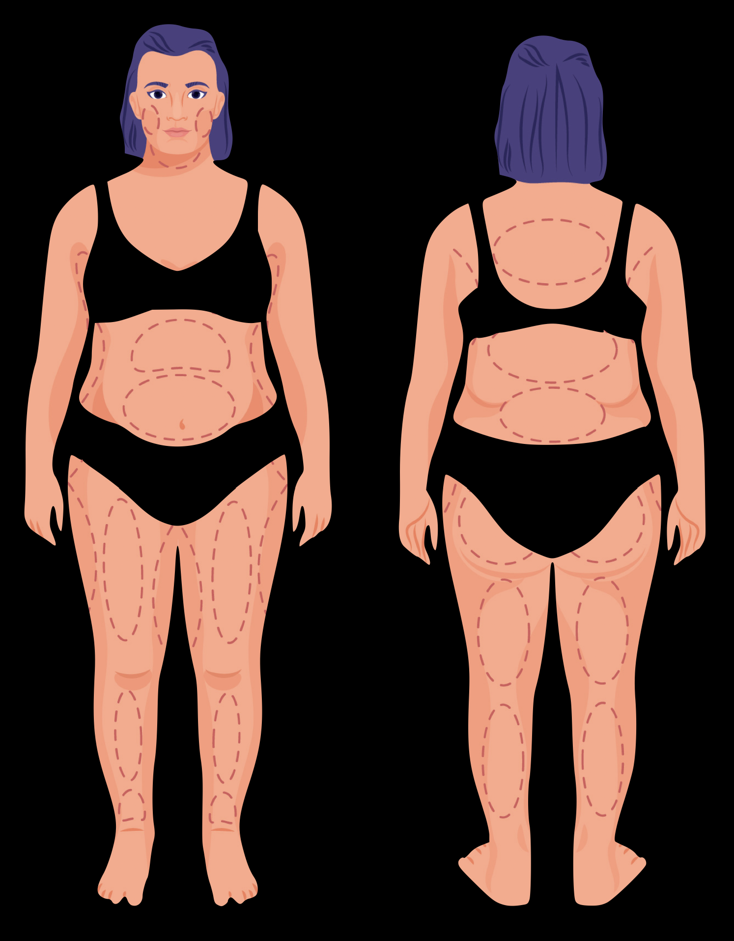 Liposuctie kan worden aanbevolen voor een verscheidenheid aan lichaamsgebieden zoals buik, armen, rug en dijen.