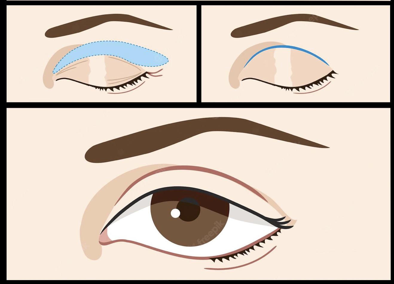 Bovenste ooglid correctie of blepharoplastie door dr. Karl Waked voor esthetiek en verjonging van het gezicht