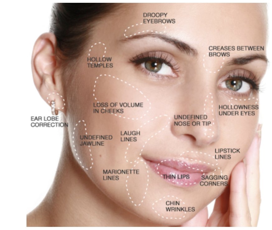 Verschillende delen van het gezicht kunnen profiteren van een dermale fillerbehandeling met HA of collageenstimulatie of een skin booster. Door het juiste product te kiezen en de meest nauwkeurige techniek toe te passen, krijgt u de beste resultaten.