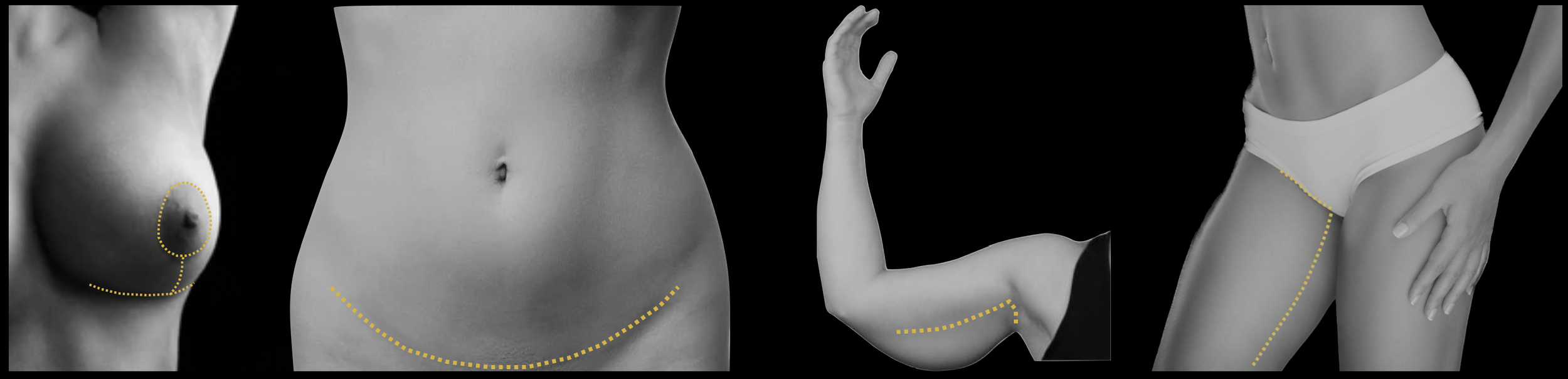 Post-bariatrische chirurgie of chirurgie na massaal gewichtsverlies kan een borstlift, buikwandcorrectie, armlift en dijlift omvatten.