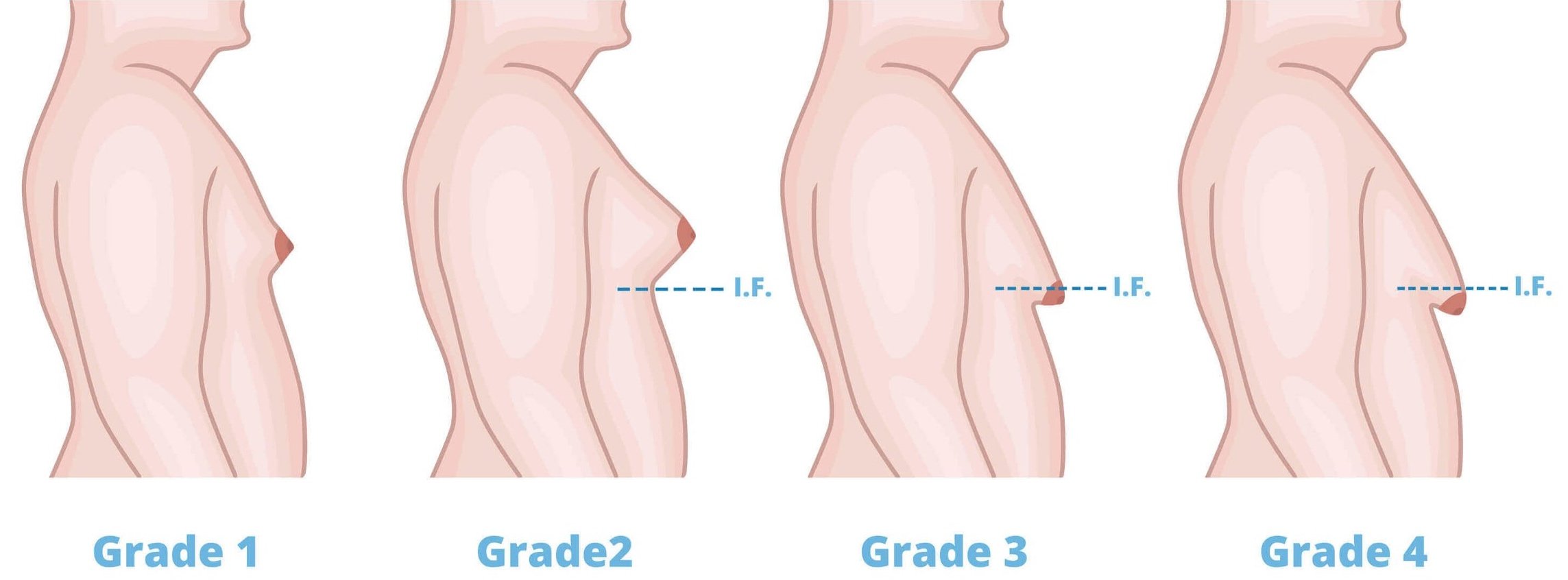 Er zijn 4 graden van mannelijke gynaecomastie