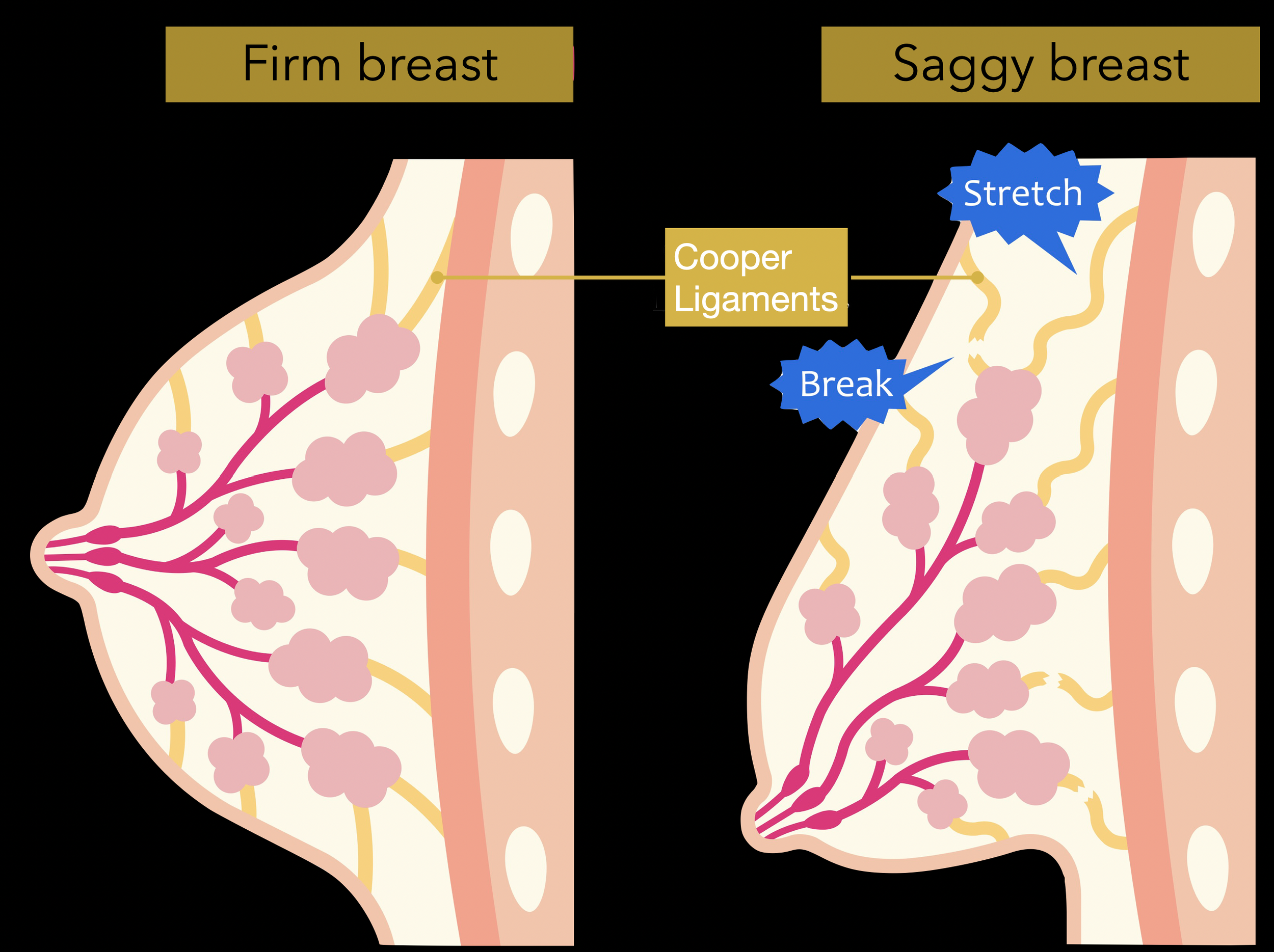 Naarmate de borst ouder wordt, rekken de weefsels en de ondersteunende ligamenten uit en verslappen.