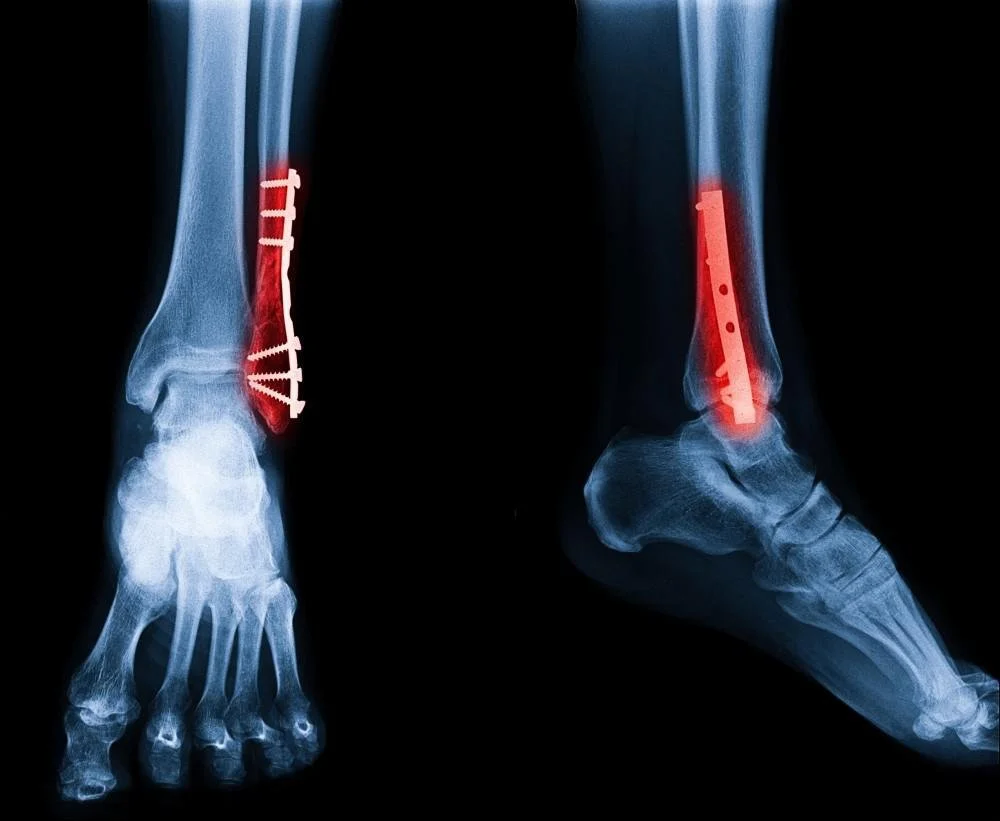 ankle fracture (broken ankle) with plates and screws