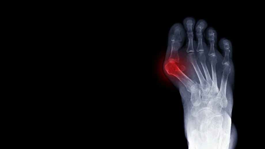 bunion deformity (or hallux valgus) of the foot