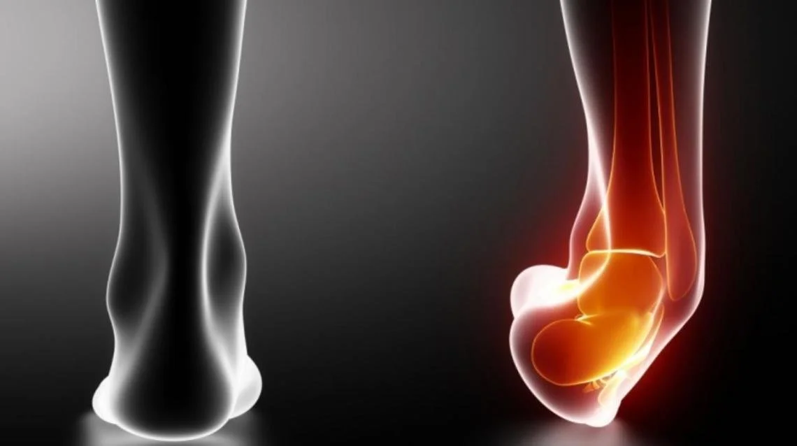 deformity of the ankle and hindfoot