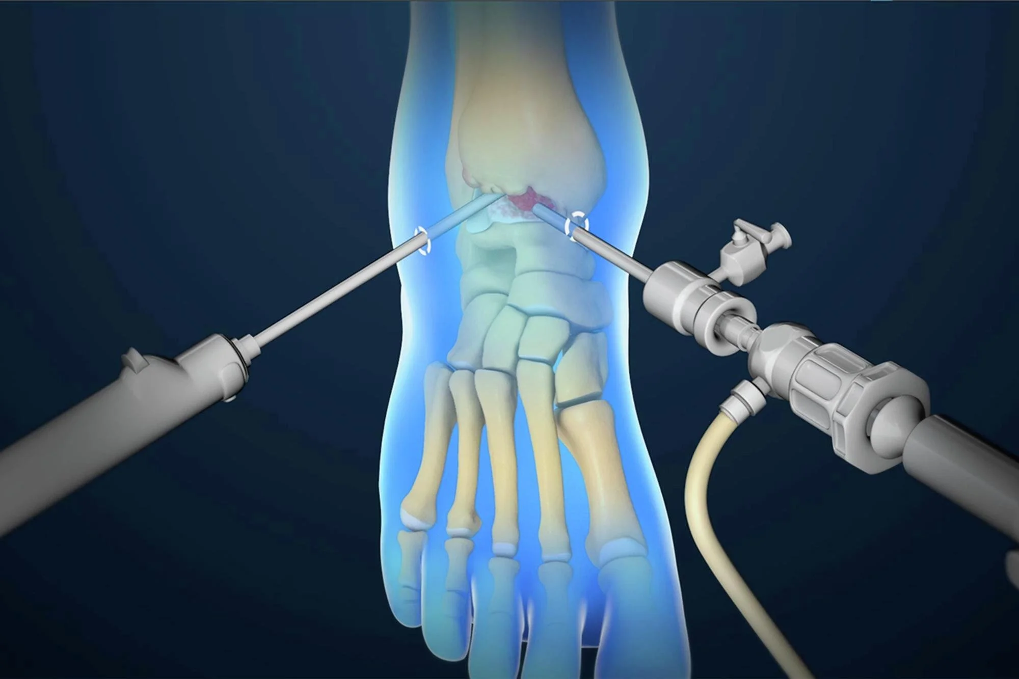 ankle arthroscopy using minimally invasive cameras in the ankle joint