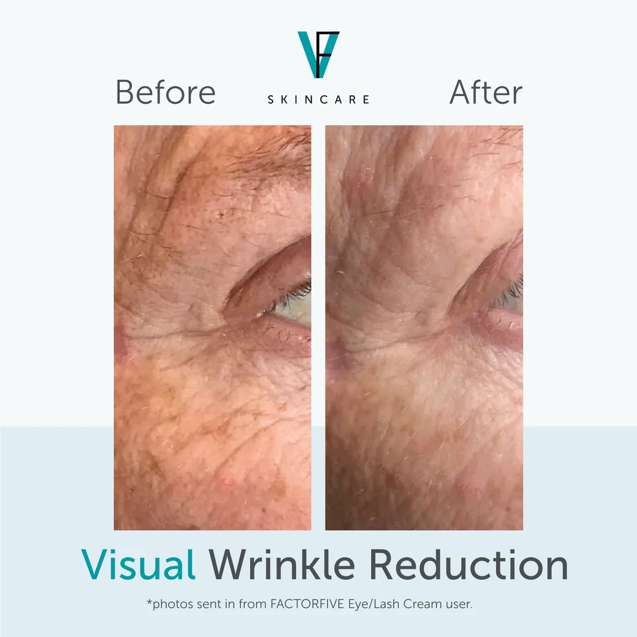 eyelash_cream_results_crows_feet_wrinkles_2.png.webp
