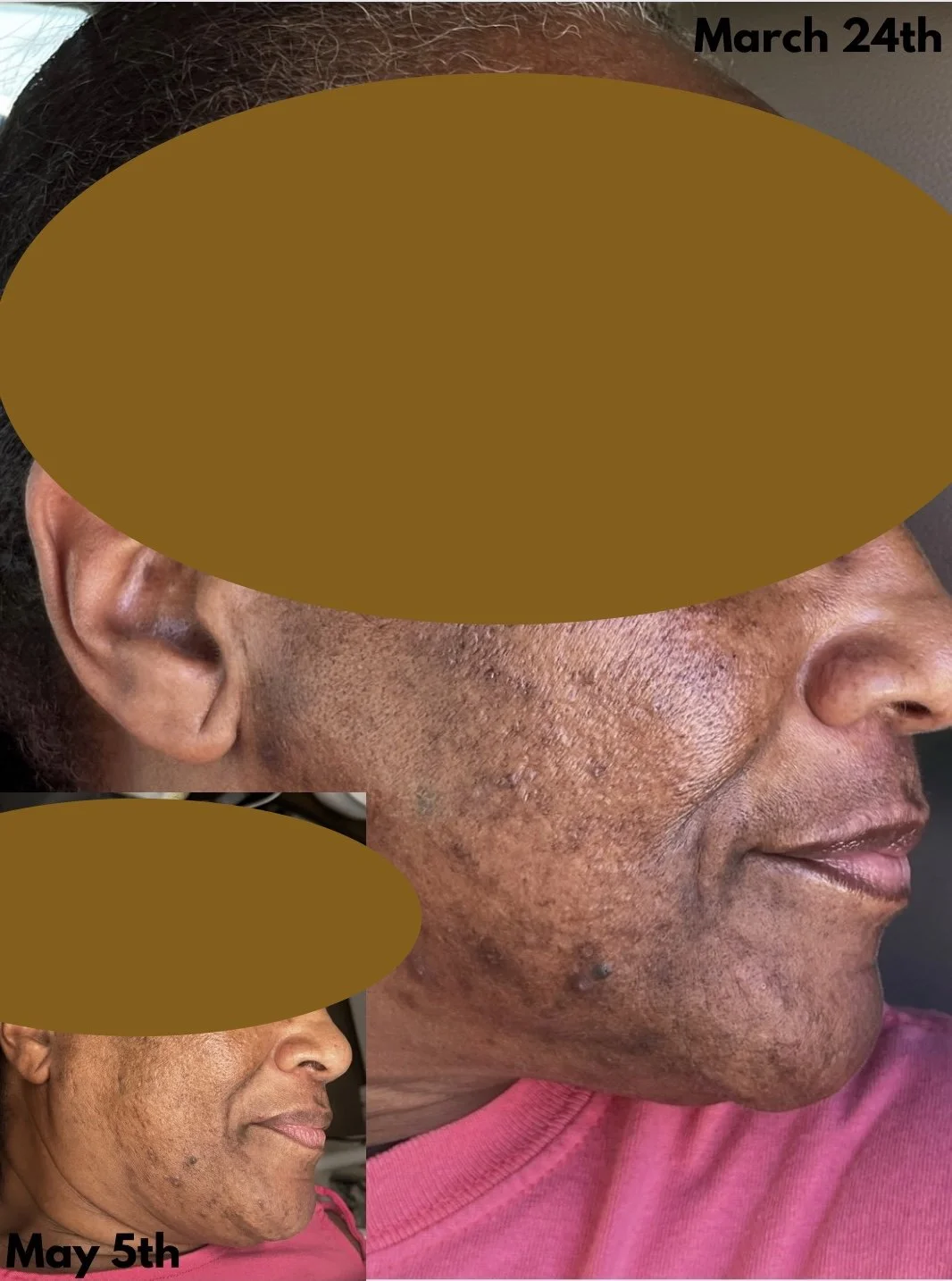Hyperpigmentation and texture clearup
