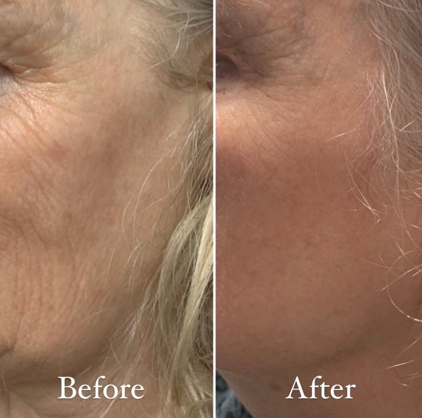 Another client having amazing results with ipl treatments! Before picture was her first treatment the beginning of November she had three treatments the second picture was taken the day after her 4 th treatment at the end of January. She is also on a