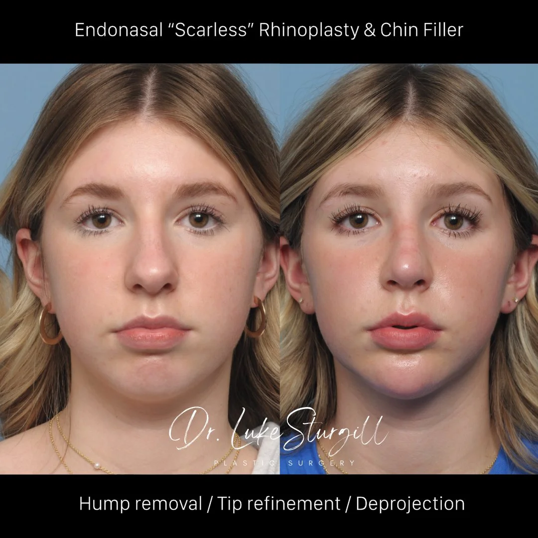 Rhinoplasty before and after — lateral view — female patient