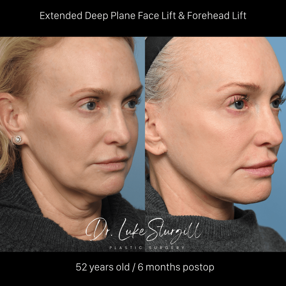 Extended deep plane facelift and forehead lift before and after — oblique view — six months post-op