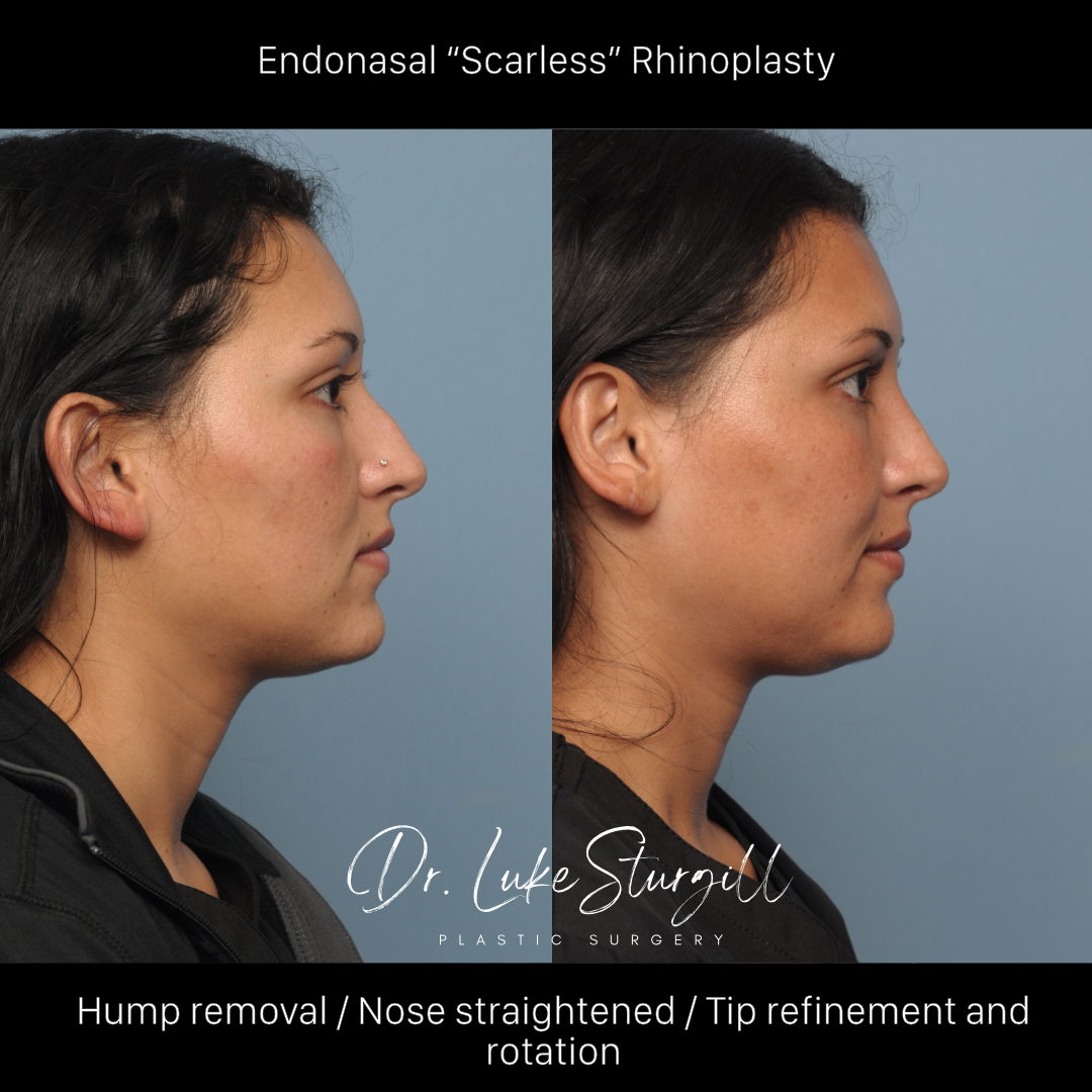 Rhinoplasty before and after — base view — female patient