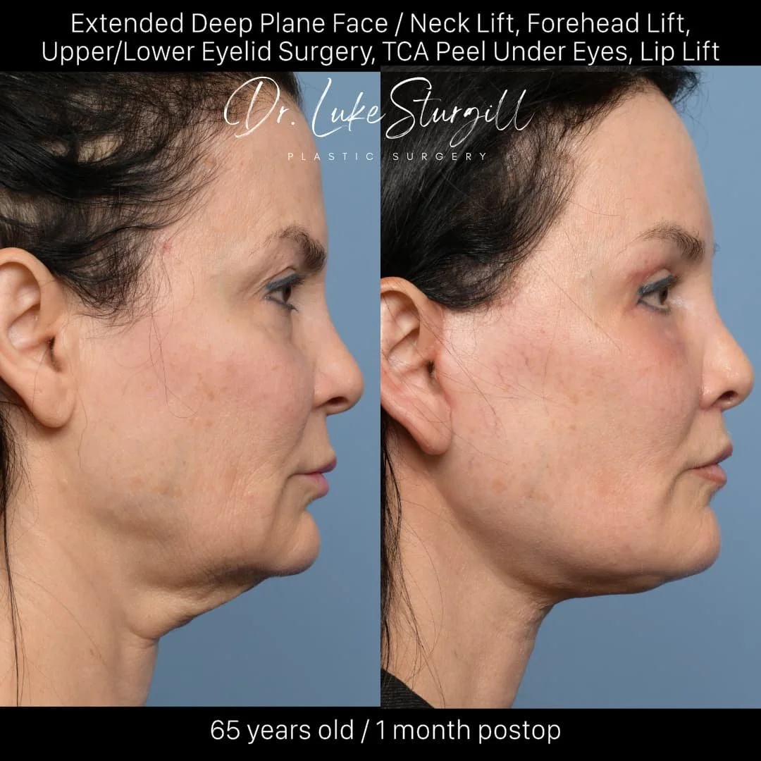 Side-by-side before and after photos of a 65-year-old woman's face showing results from plastic surgery, including face and neck lift, forehead lift, eyelid surgery, TCA peel under the eyes, and lip lift, taken one month post-operation.