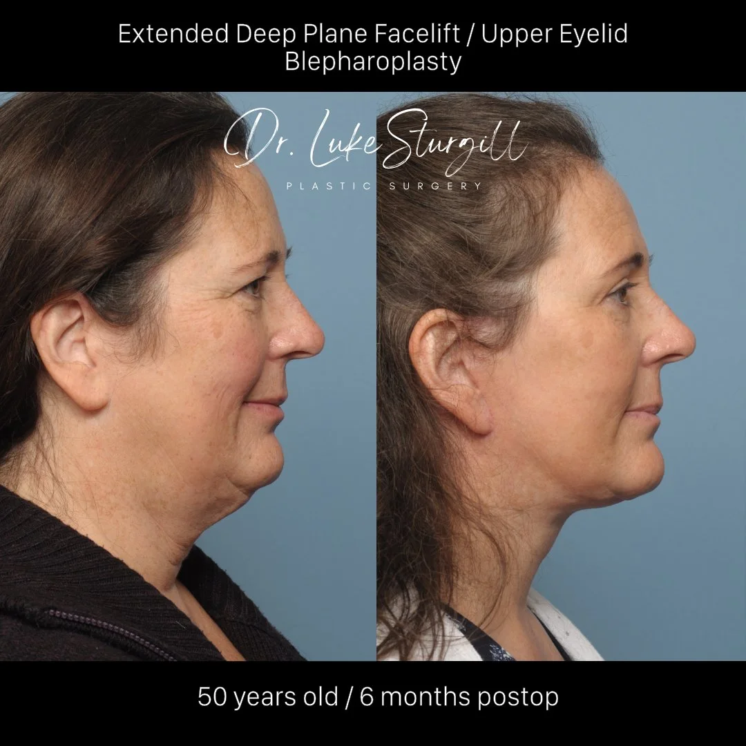 Deep plane facelift 6 months post-op — before and after — front view