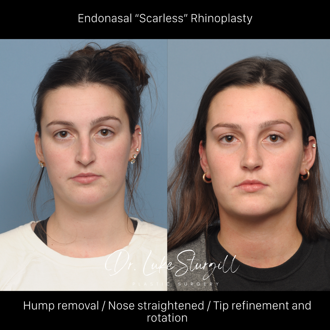 Rhinoplasty before and after — oblique view — female patient