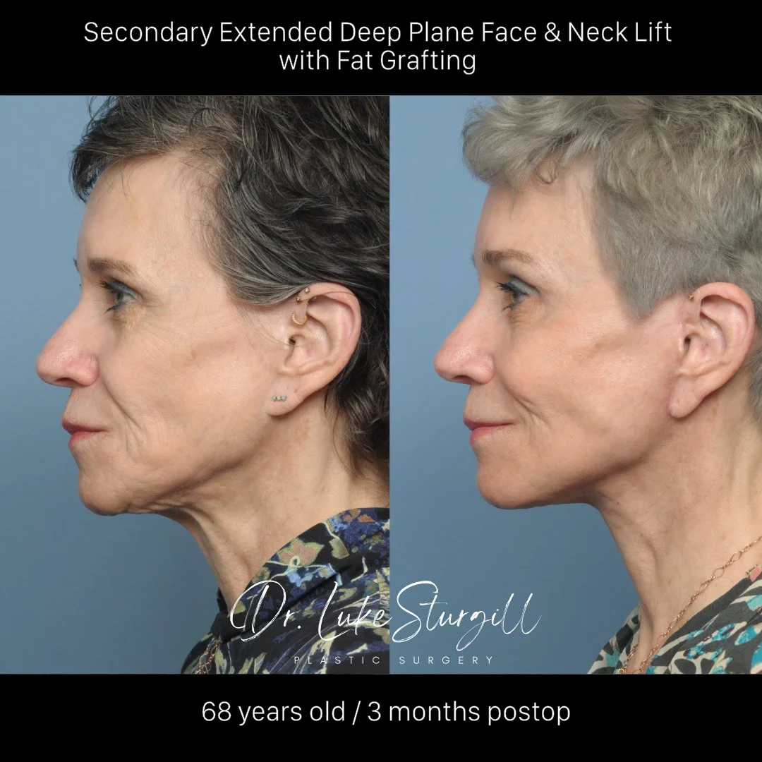 Deep plane facelift 3 months post-op — before and after — lateral view