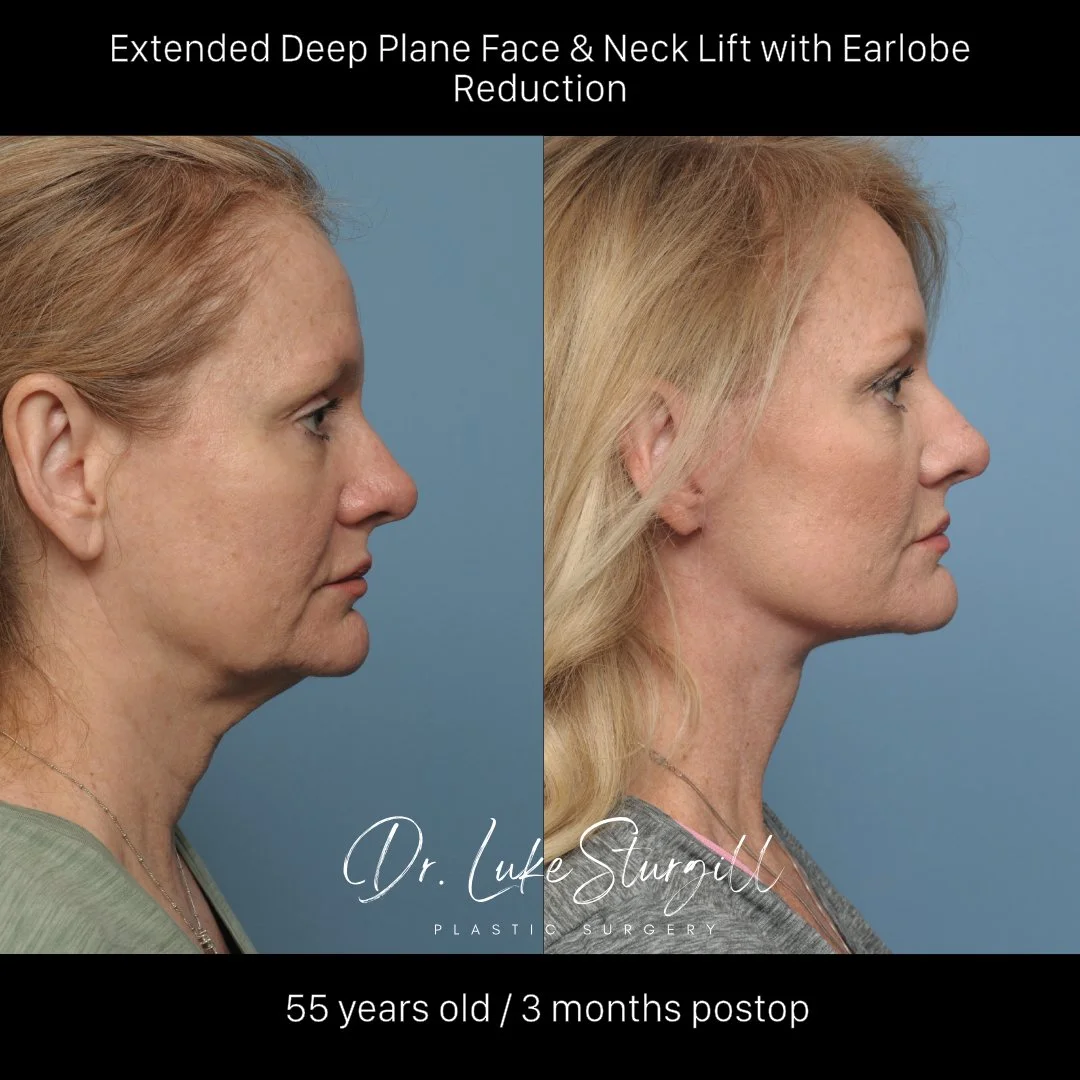 Deep plane facelift before and after — front view — female patient