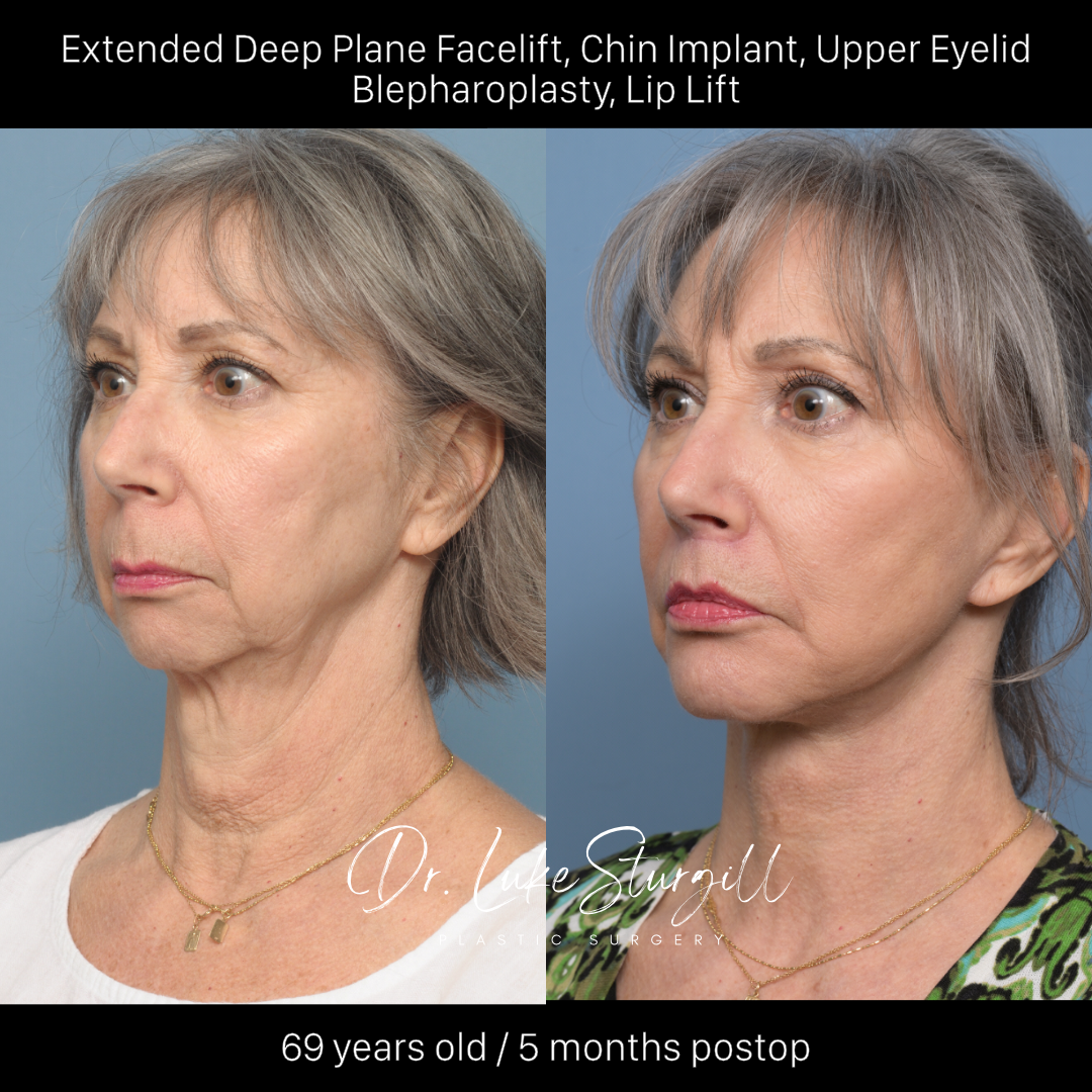 Deep plane facelift before and after — oblique view — female patient