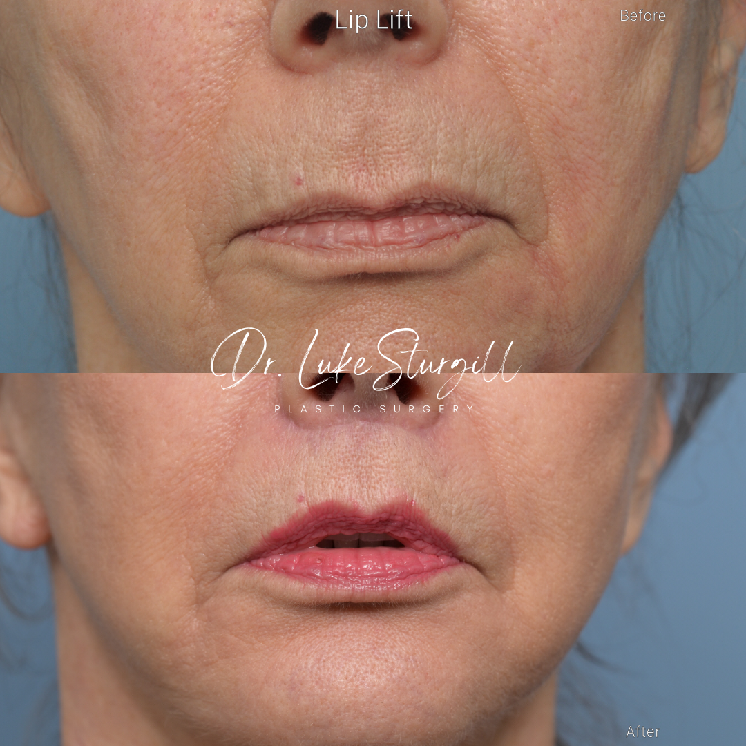 Lip lift before and after — front view — female patient