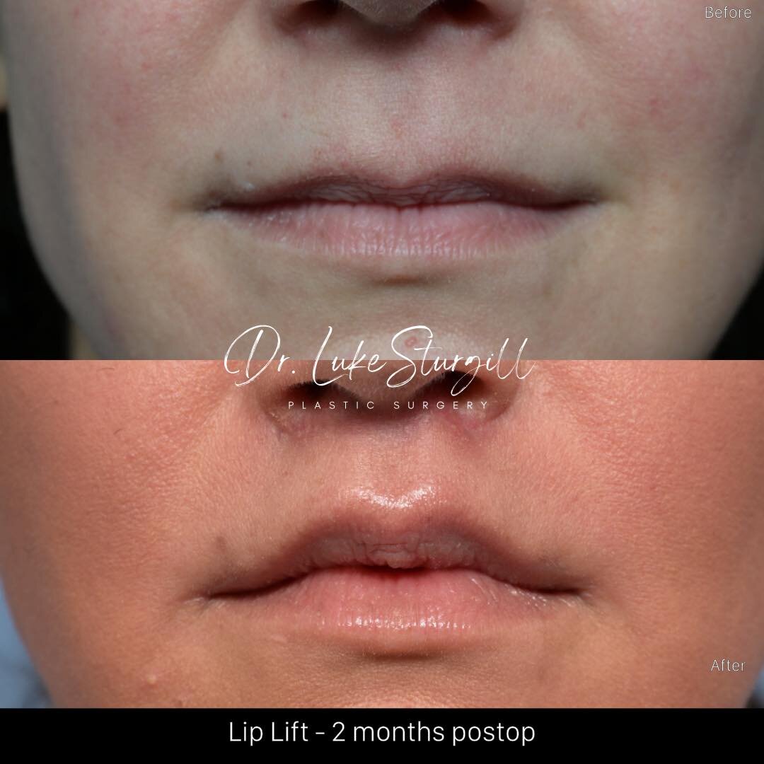 No Fillers, Just Natural Results! 

Swipe left to see the natural enhancement of a lip lift - without any fillers! This patient desired a more permanent solution with results that speak for themselves. 

Why consider a lip lift?
* No fillers: For tho
