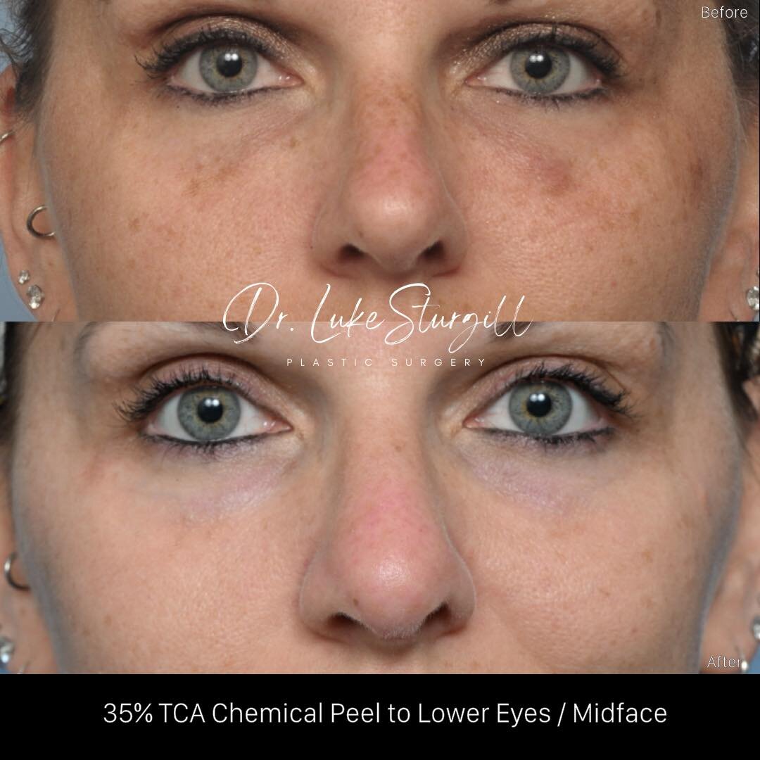 When pigment is the cause of under-eye dark circles&hellip; 

Not all under-eye dark circles are due to bags or lack of sleep. In some cases, they are actually caused by pigment changes in the skin. For these patients, surgery is NOT the solution. In