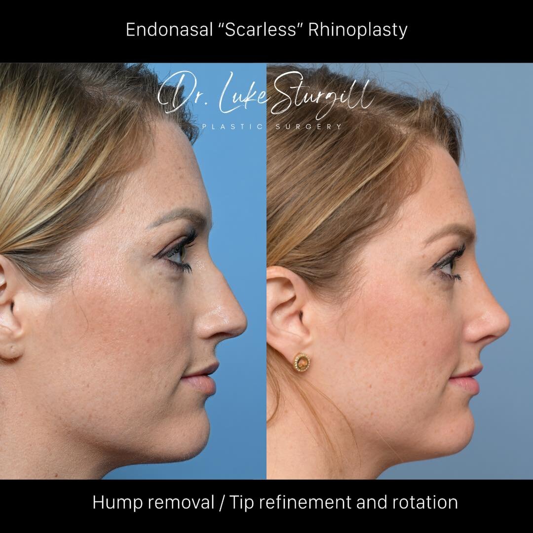 Rapid recovery, remarkable results - My Closed &ldquo;Scarless&rdquo; Rhinoplasty Technique 

Many patients ask, &quot;What will my nose look like one month after surgery?&quot; The photo above showcases my lovely patient who underwent my Closed &quo