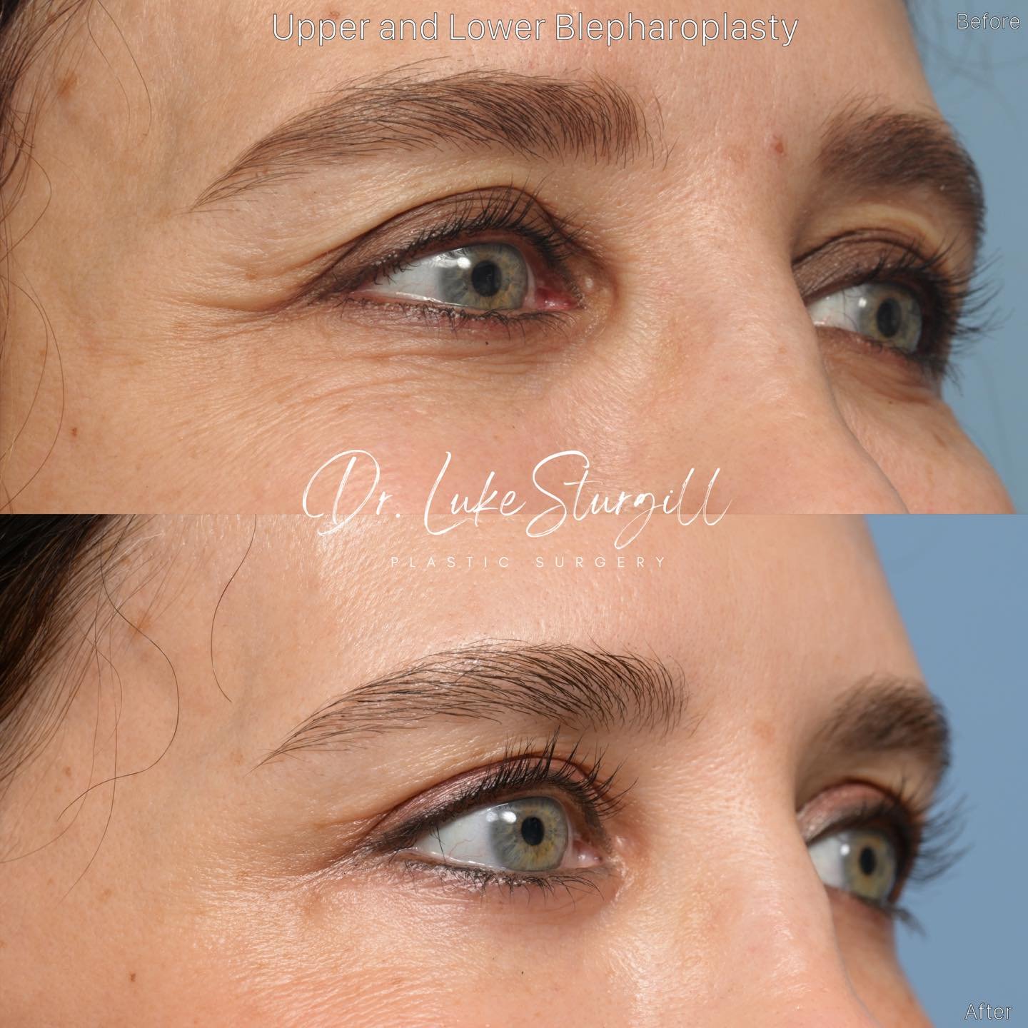 Solving the Puzzle of Eyelid Skin

The subtleties of lower eyelid skin issues:
* some patients have crepey skin only, and do not need any skin removed. These patient&rsquo;s are best treated with resurfacing techniques (chemical peel (35% TCA or Phen