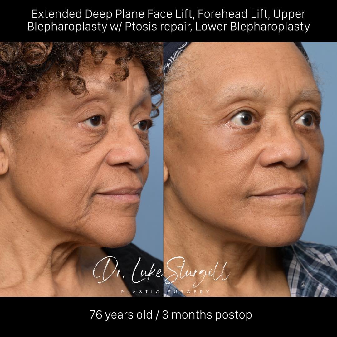 Many patients ask - When is too old to get a facelift? 

There is NO strict upper age limit; it's all about your health and vision for yourself. One of my most memorable transformations was at 83 years!

Today, I&rsquo;m proud to showcase this transf