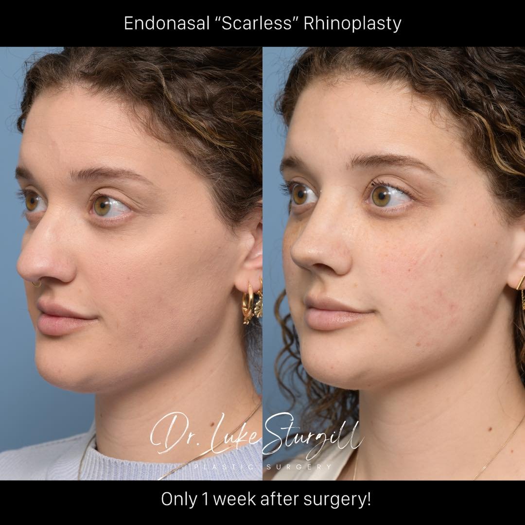 What will my nose look like 1 week after surgery? 

Swipe ➡️ to see the benefits of my Endonasal &quot;Scarless&quot; Rhinoplasty technique. 
Only ONE WEEK post-procedure, and the transformation is remarkable. No visible scars, less swelling, and fas