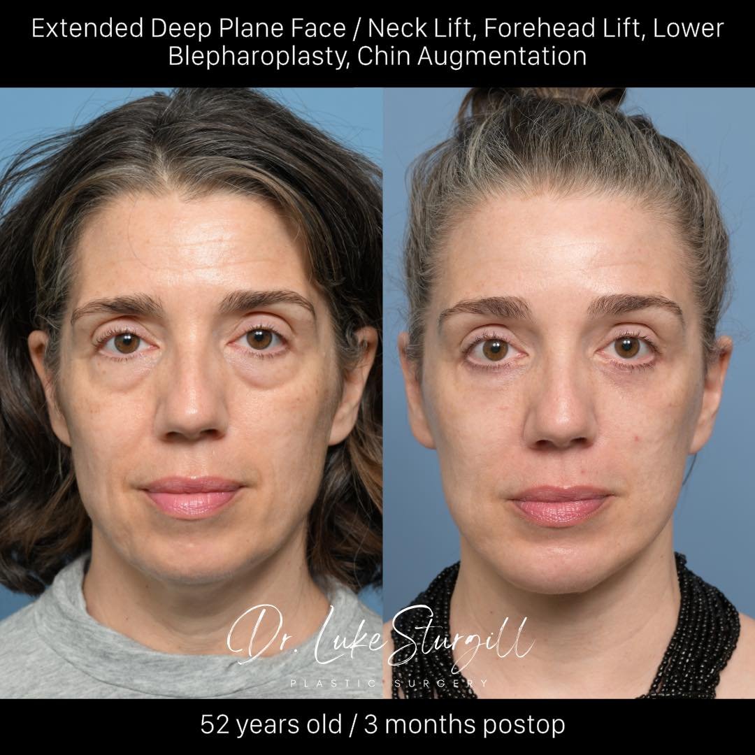 Comprehensive Facial Rejuvenation

This is the stunning transformation of my incredible 52-year-old patient after a comprehensive facial rejuvenation that includes my signature extended deep plane face and neck lift, an endoscopic forehead lift, lowe