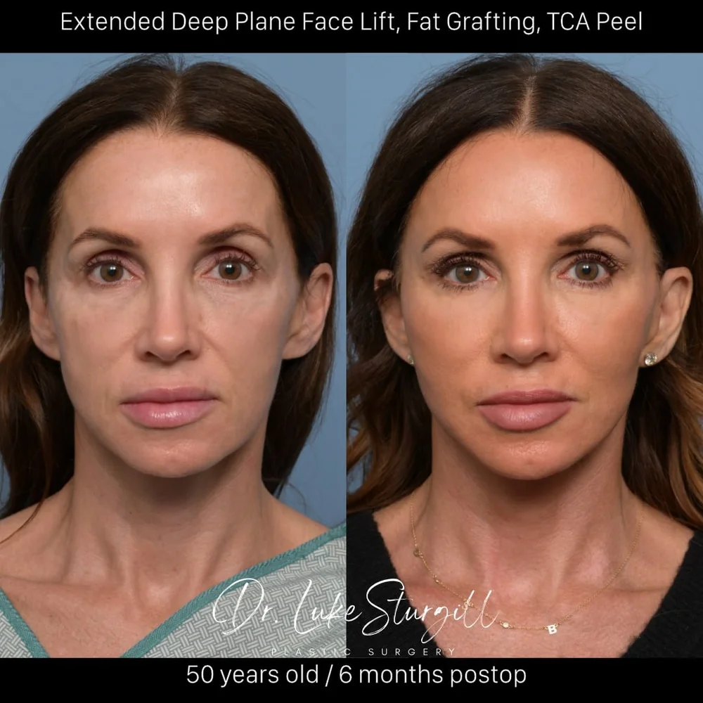 Deep plane facelift before and after — front view — female patient