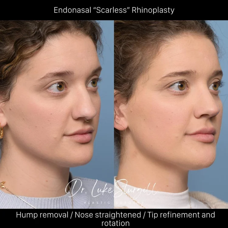 Scarless Endonasal Rhinoplasty Before and After