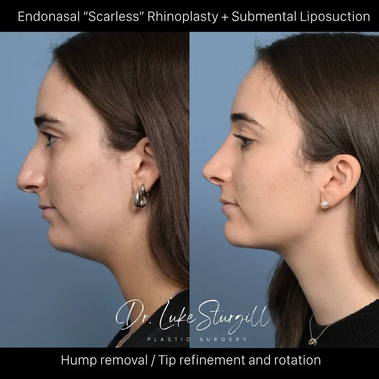 Rhinoplasty New York Patient Before and After