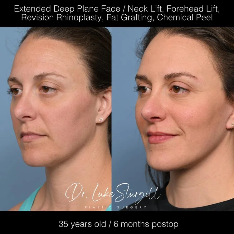 Deep Plane Facelift 35 Year Old Patient Before and After