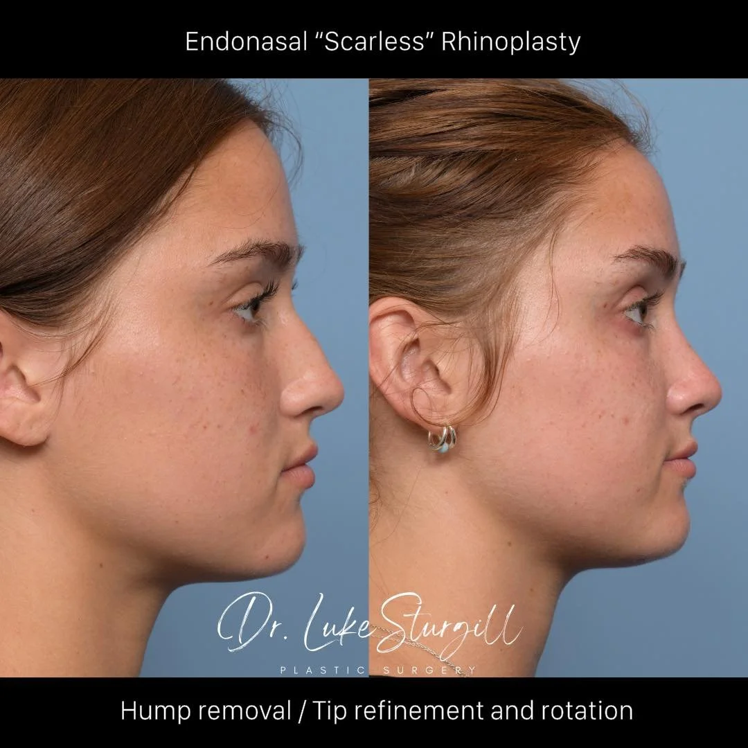 Scarless Rhinoplasty 

Swipe to see how small changes can make a big difference.
This patient wanted a softer, more feminine profile while still looking 100% like herself.

What I did:
&bull; Removed the dorsal hump
&bull; Refined and slightly rotate