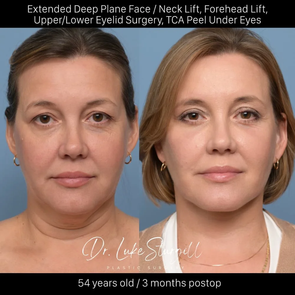 Deep plane facelift before and after — front view — female patient