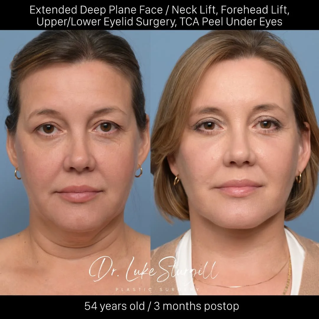 Extended Deep Plane Face and Neck Lift before and after by Dr. Luke Sturgill — unretouched patient, three months post-op, front view