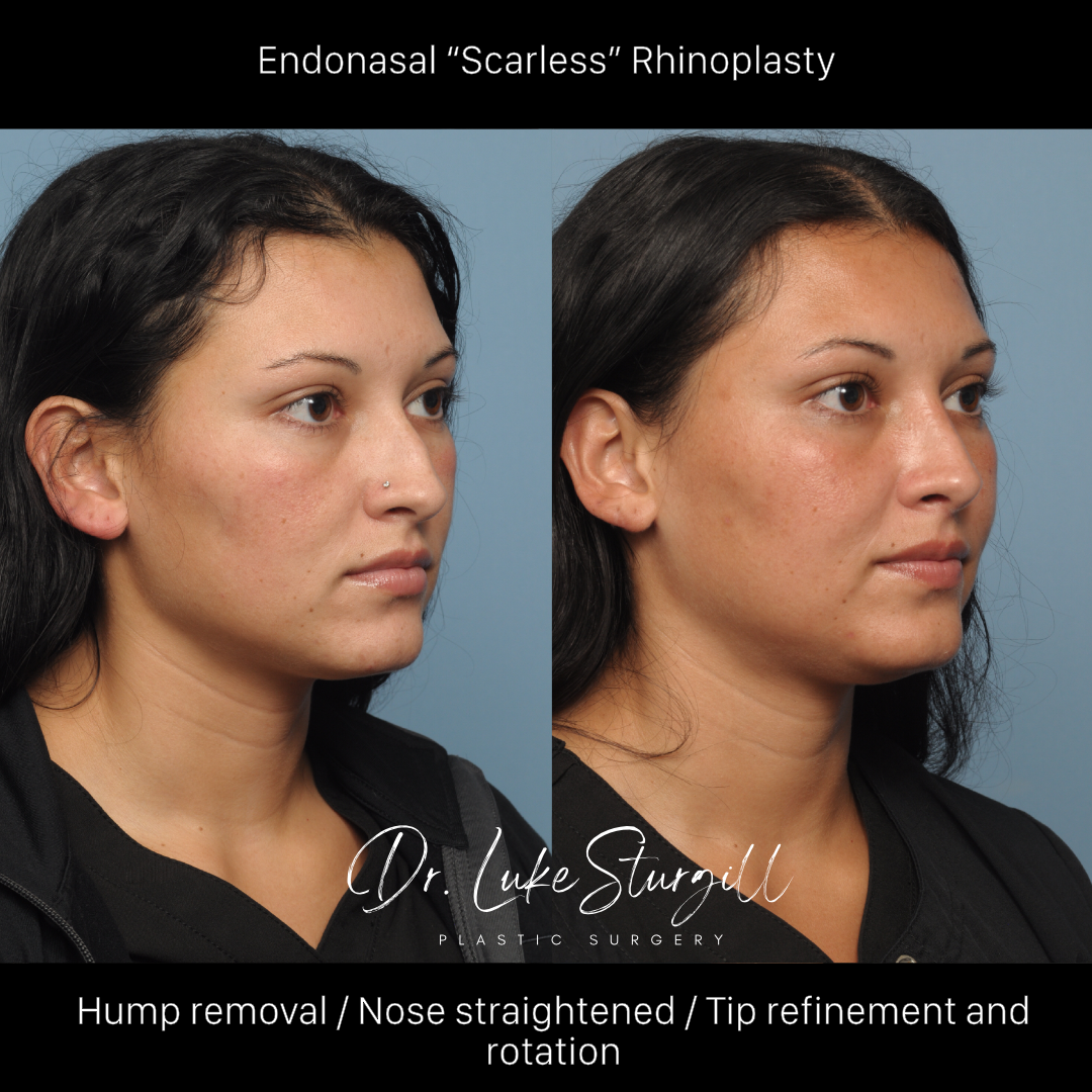 Rhinoplasty before and after — oblique view — female patient